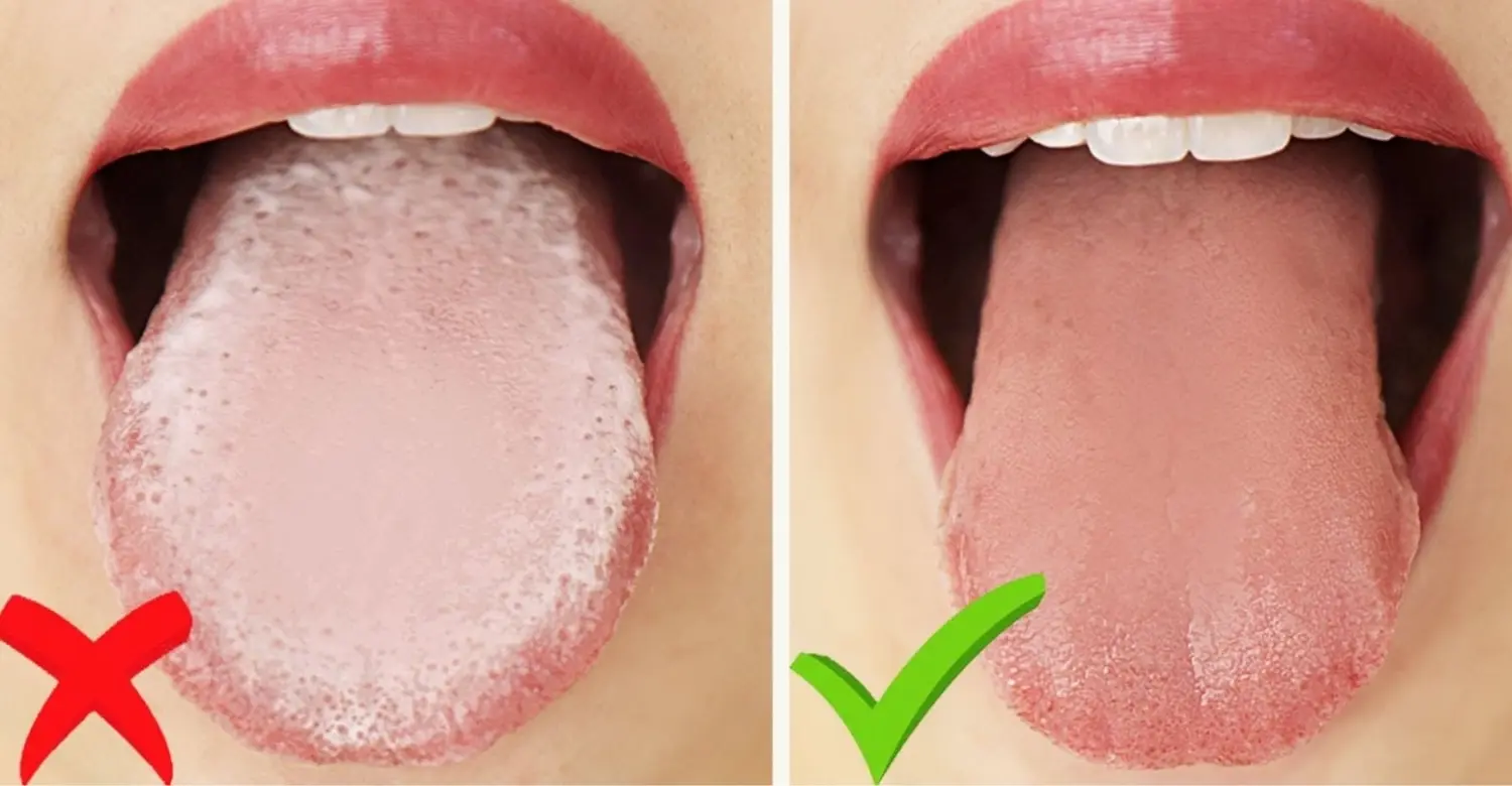 Tongue Cleaning 2